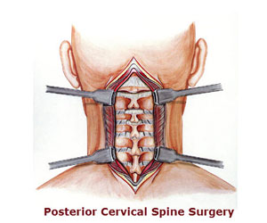 Cervical Spine Surgeon in Hyderabad